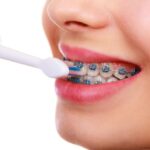 The Hidden Benefits of Orthodontic Braces: Paving The Way For Oral Rejuvenation