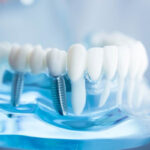 Dental Implant Chronicles: 10 Things To Know Before Getting Them