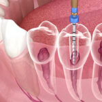 How Do You Figure Out If You Need a Root Canal?